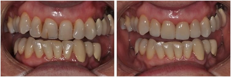 Patient before and after Emax Crowns at Rebol Family Dentistry