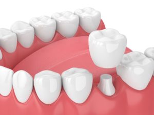 dental crown benefits Asheville North Carolina