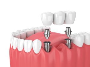 implant dentistry in Asheville North Carolina