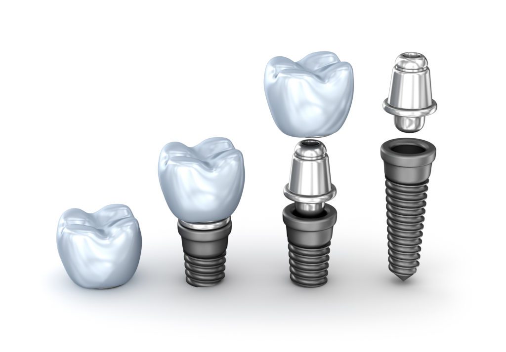 Dental Implant Process in Asheville, NC