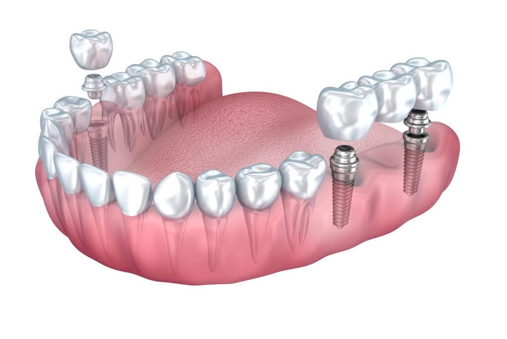 Cost of dental implants in Asheville, NC