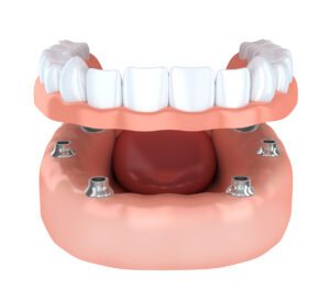 Dental Implants vs Dentures Asheville North Carolina