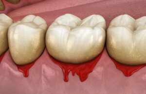 preventative dental care for your gums