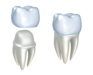 Despite their durability, a dental crown can occasionally loosen or fall off, leading to an increased risk of further damage.